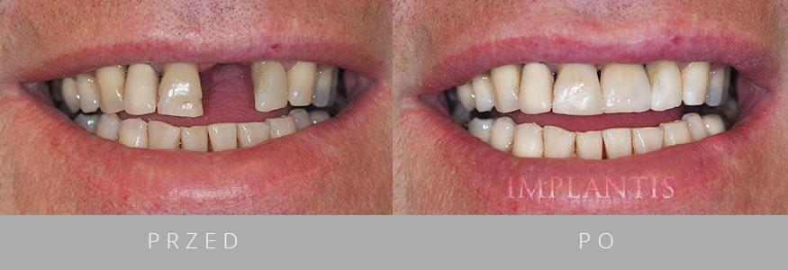 widok przed i po wszczepieniu implanta zębowego