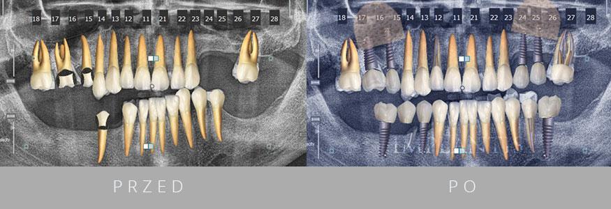 Zęby przed i po leczeniu w Klinice Implantis w Krakowie