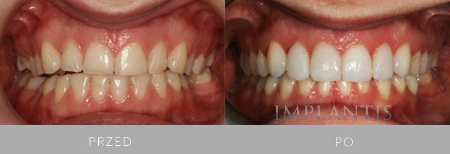 zęby przed i po leczeniu w Implantis w Krakowie