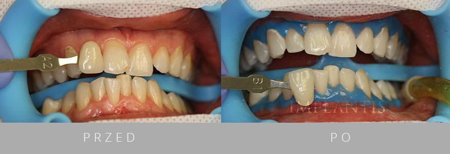 Implanty zębów Kraków