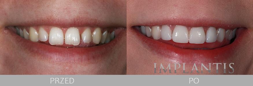 zęby przed i po leczeniu w Implantis w Krakowie