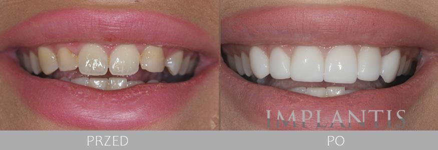 Zęby przed i po leczeniu w Implantis