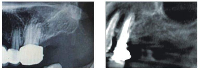 Dobra jakość tomografii jest ważna dla planowania implantów