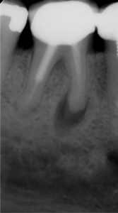 jamie ustnej, korony pełnoceramiczne, możliwość skorzystania, system kanałowy, ekspertów zajmujących, endodoncja, pierwszym etapem, konsultacja, komory, gabinet