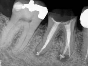 dział stomatologii zajmujący, pole zabiegowe, zabieg endodoncji, trakcie zabiegu, leczenie kanałowe endodoncja, pacjenci, jedynym sposobem
