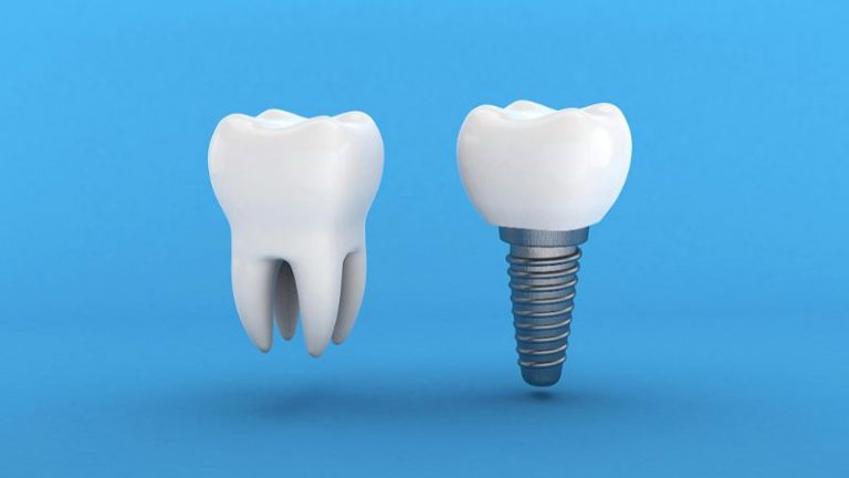 Jak wygląda implant zęba?