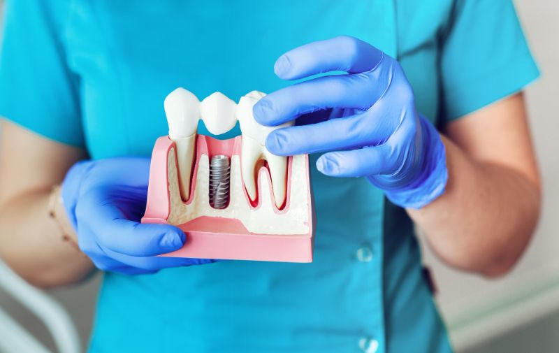 wstawienie implantu zęba Kraków, Implanty zębowe