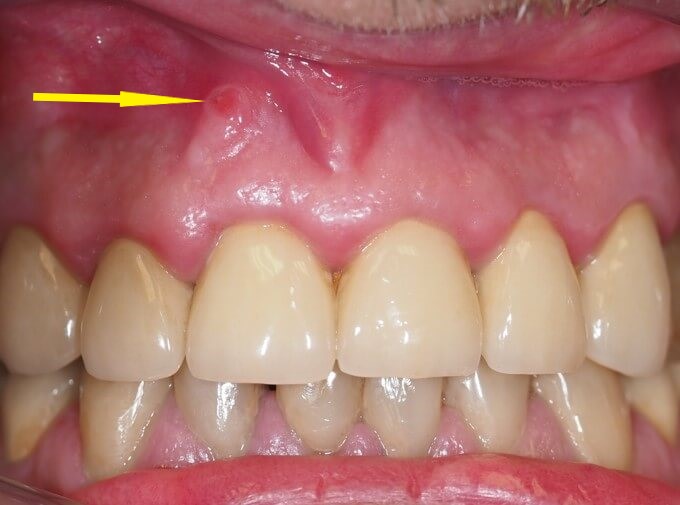 leczenie przetoka zębowa, objawy przetoki zębowej, obraz wytworzenia przetoki, objawy przetoki, zdjęcie przetoki zębowej na dziąsle