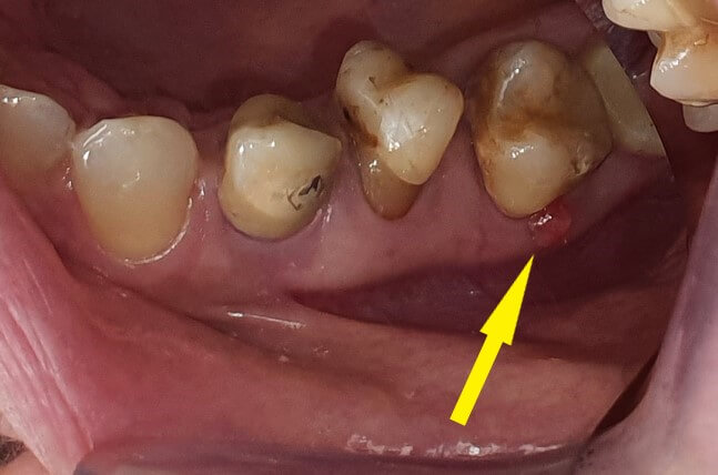 zdjęcie przetoka na dziąśle, foto przetoka zęba, leczenie
