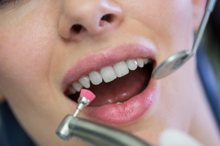 Szlifowanie zębów – na czym polega? Czy jest bezpieczne? Ile kosztuje?