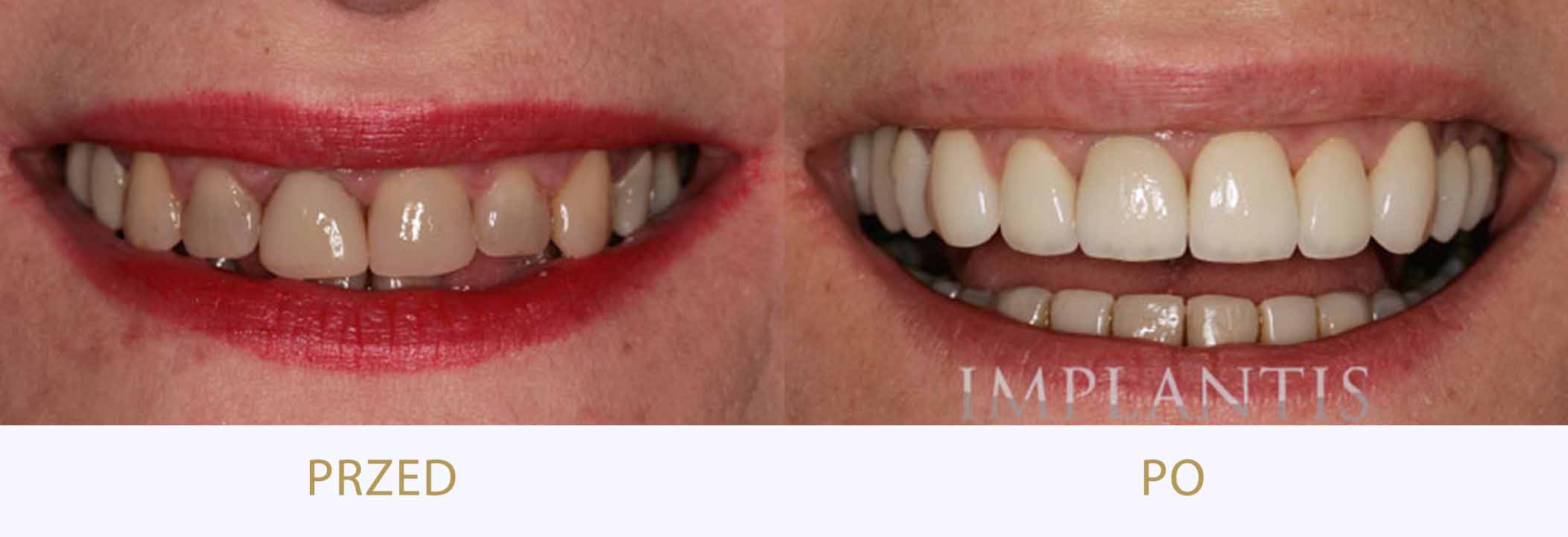 zęby przed i po leczeniu, poprawa estetyki uśmiechu