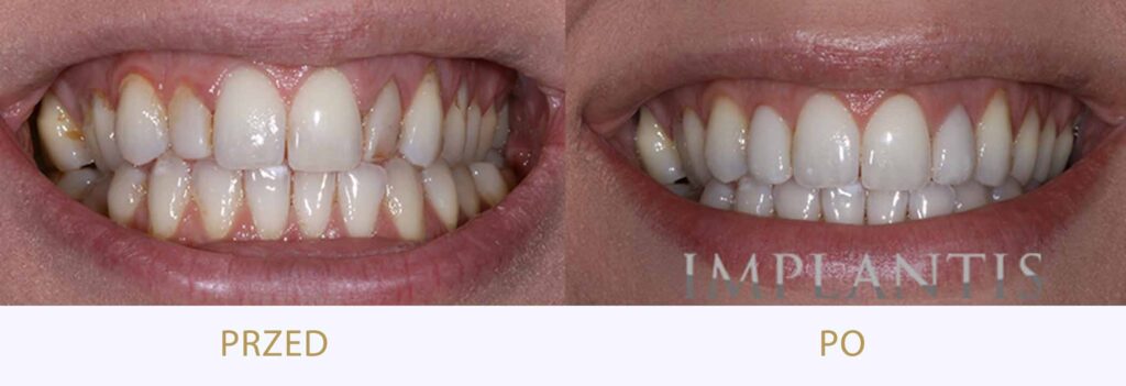 Zęby przed i po leczeniu: Bonding i wybielanie