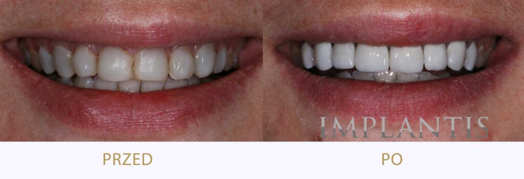 Zęby przed i po leczeniu: Bonding zębów