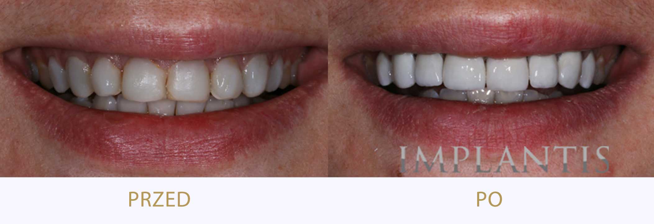 zęby przed i po bondingu
