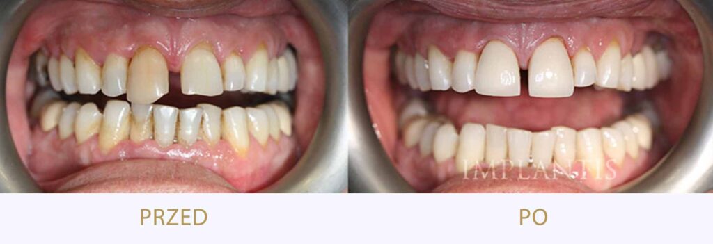 Zęby przed i po leczeniu: Dwie korony porcelanowe oraz higienizacja