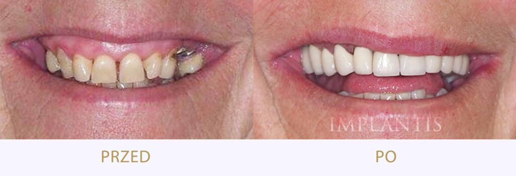 Zęby przed i po leczeniu: Rekonstrukcja uśmiechu: implanty, mosty, korony porcelanowe