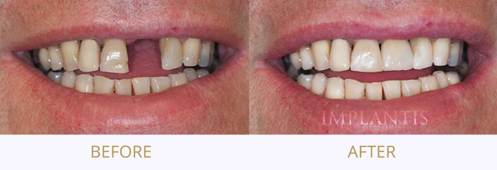 Zęby przed i po leczeniu: Korona porcelanowa na implancie