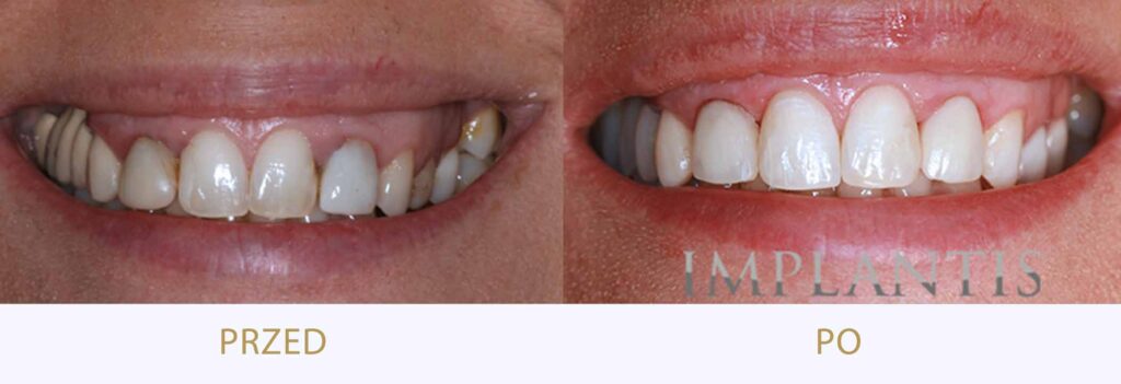 Zęby przed i po leczeniu: Korony i bonding
