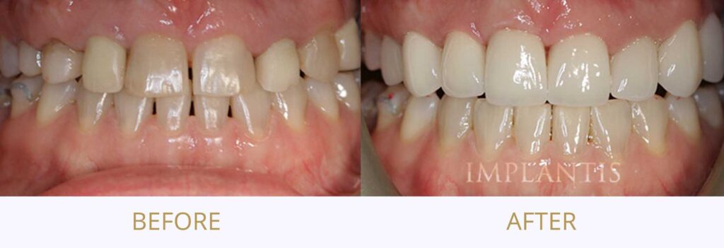 Zęby przed i po leczeniu: Korony i licówki porcelanowe
