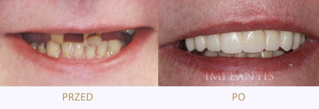 Zęby przed i po leczeniu: Korony i mosty cyrkonowe
