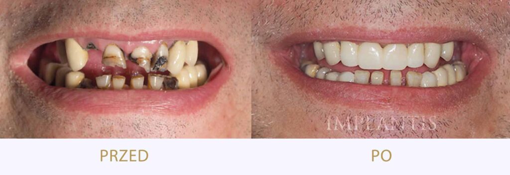 Zęby przed i po leczeniu: Korony kompozytowe