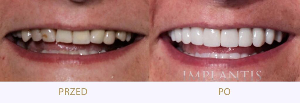 Zęby przed i po leczeniu: Korony na zębach własnych i na implantach