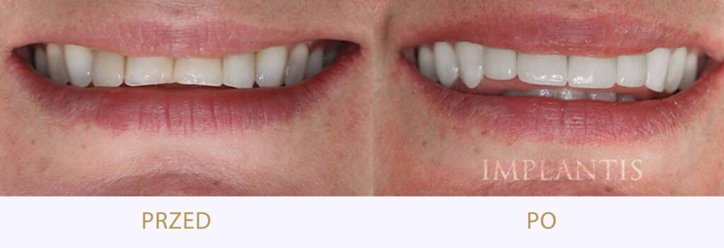Zęby przed i po leczeniu: Korony porcelanowe