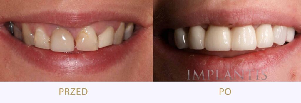 Zęby przed i po leczeniu: Korony i licówki porcelanowe