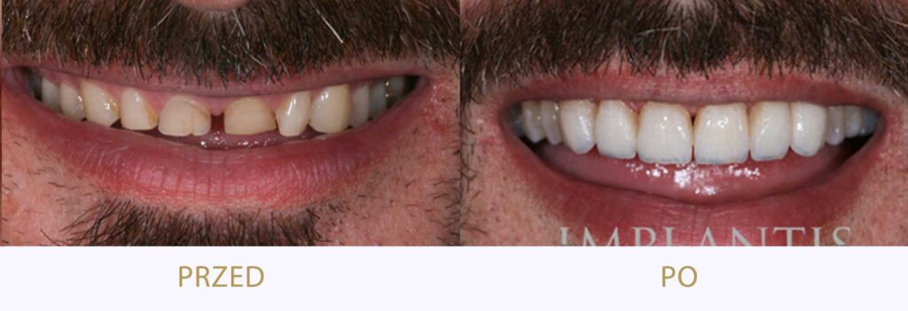 Zęby przed i po leczeniu: Licówki i korony porcelanowe