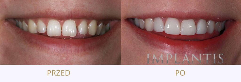 Zęby przed i po leczeniu: Licówki porcelanowe