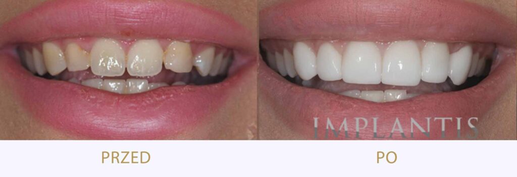 Zęby przed i po leczeniu