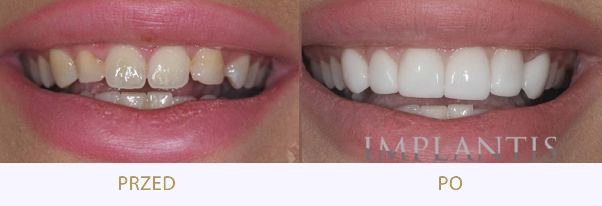 zęby przed i po leczeniu: licówki porcelanowe