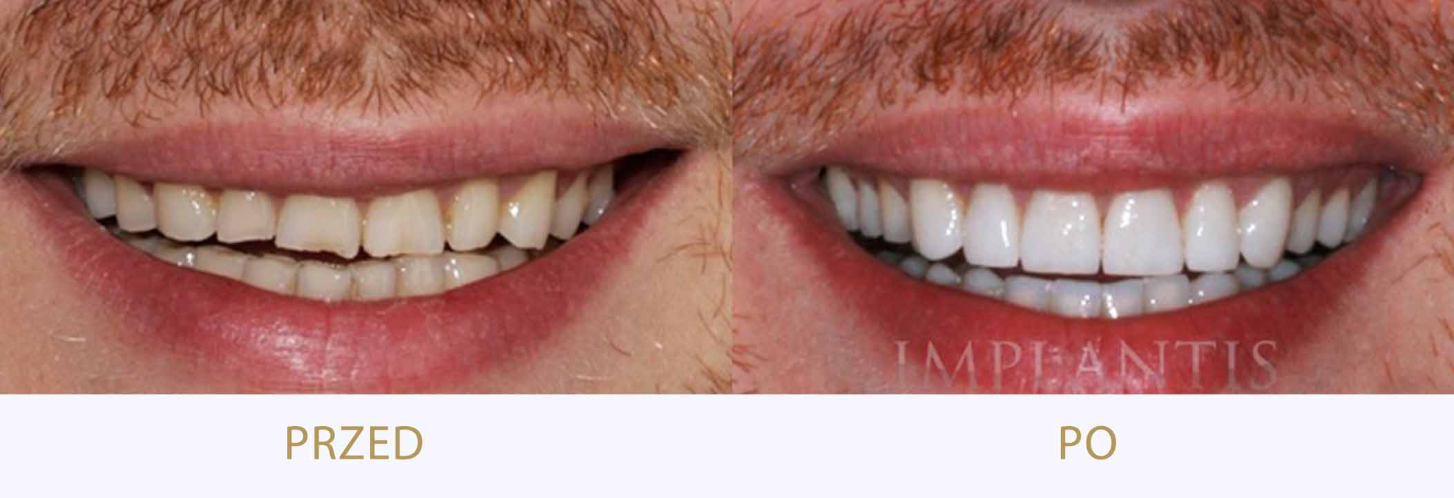 zdjęcia przed i po leczeniu przy użyciu licówek