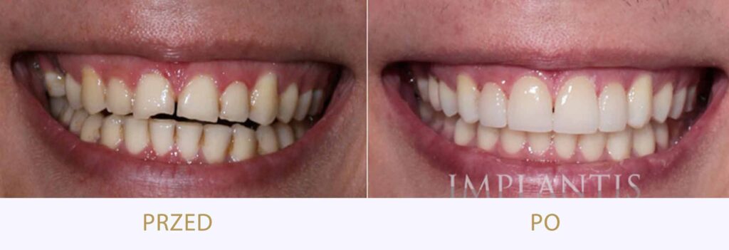 Zęby przed i po leczeniu: Licówki porcelanowe i bonding