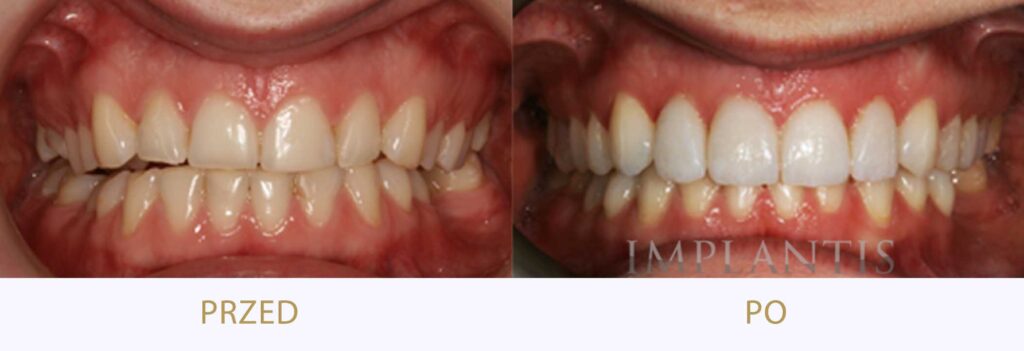 Zęby przed i po leczeniu: Licówki porcelanowe i bonding