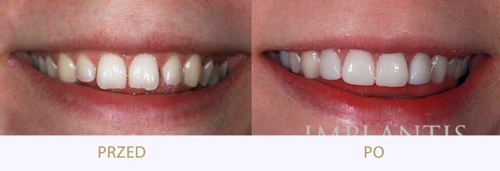 Zęby przed i po leczeniu: Licówki porcelanowe