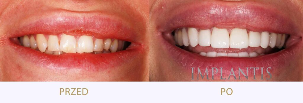 Zęby przed i po leczeniu: Licówki porcelanowe i wybielanie zębów
