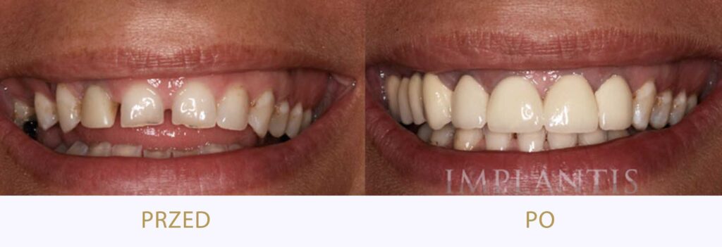 Zęby przed i po leczeniu: Licówki porcelanowe i korony porcelanowe