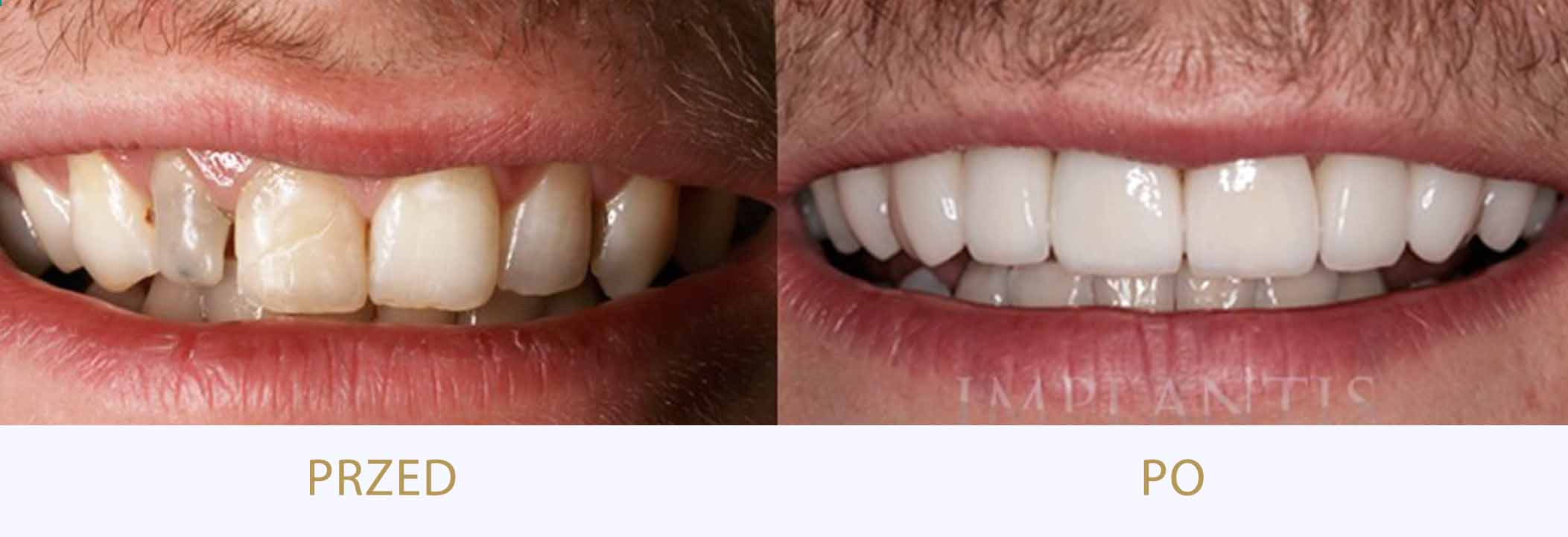 zęby przed i po leczeniu protetycznym
