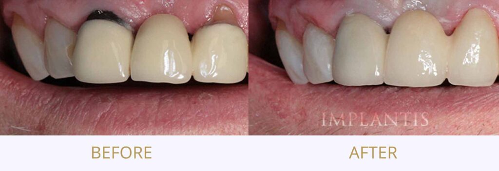 Zęby przed i po leczeniu: Most cyrkonowy