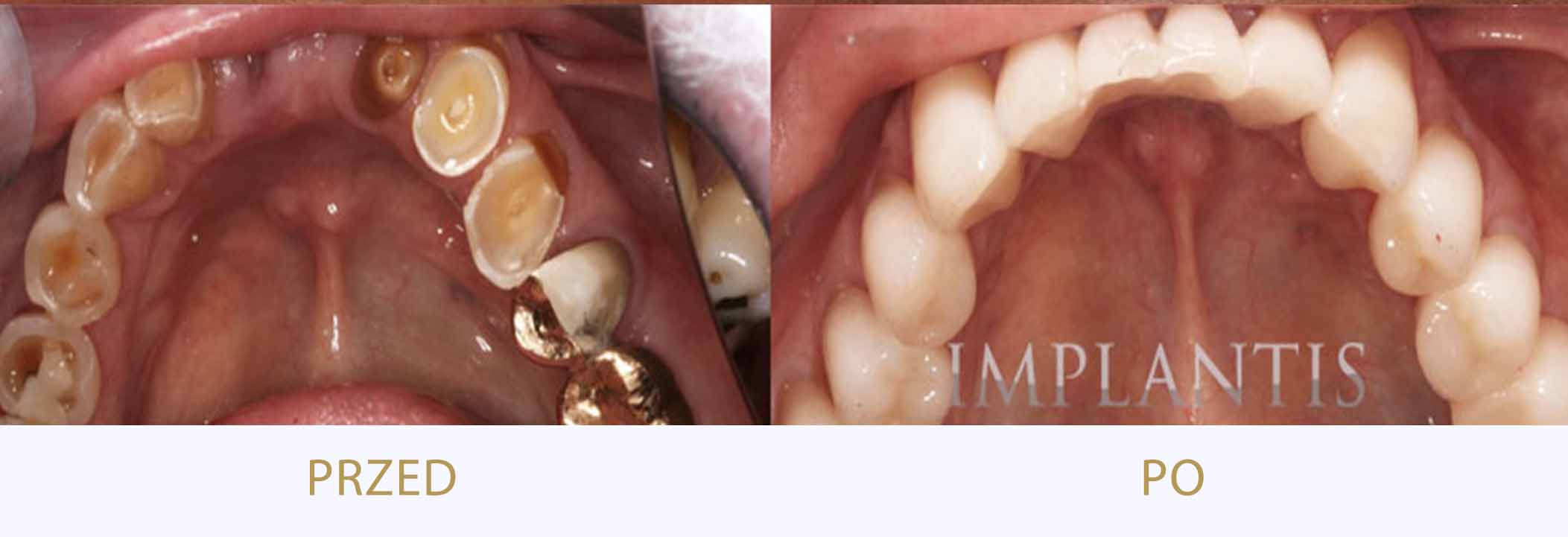 zęby przed i po osadzeniu mostu stomatologicznego