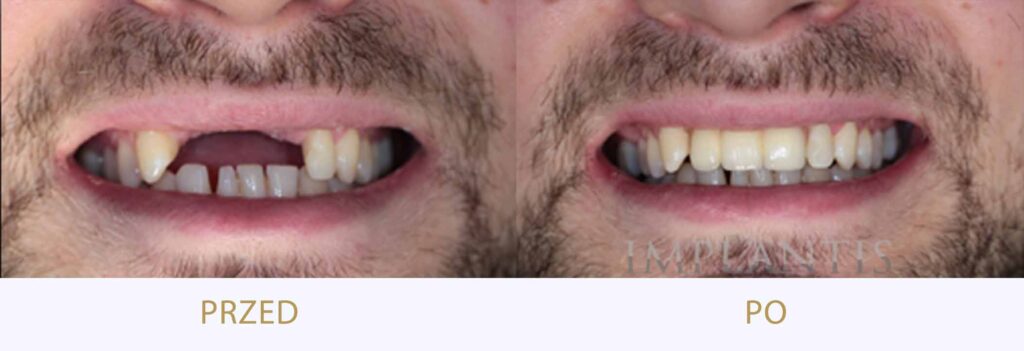 Zęby przed i po leczeniu: Most na implantach