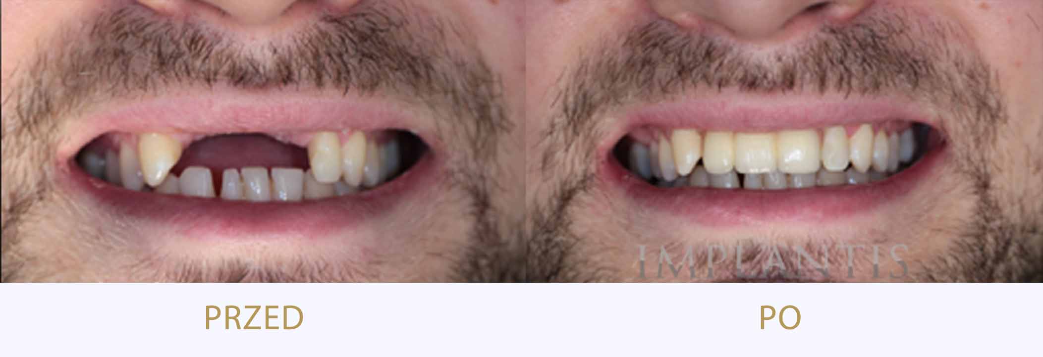 zęby przed i po leczeniu: mosty dentystyczne