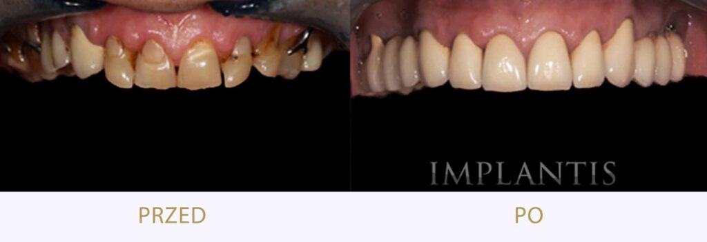 Zęby przed i po leczeniu: Mosty korony proteza