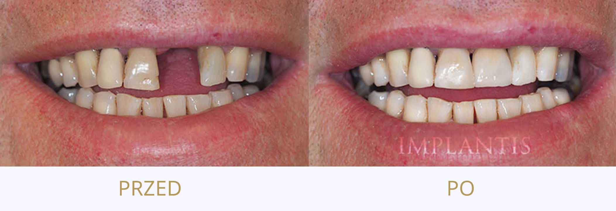 Widok przed i po wszczepieniu implanta zębowego