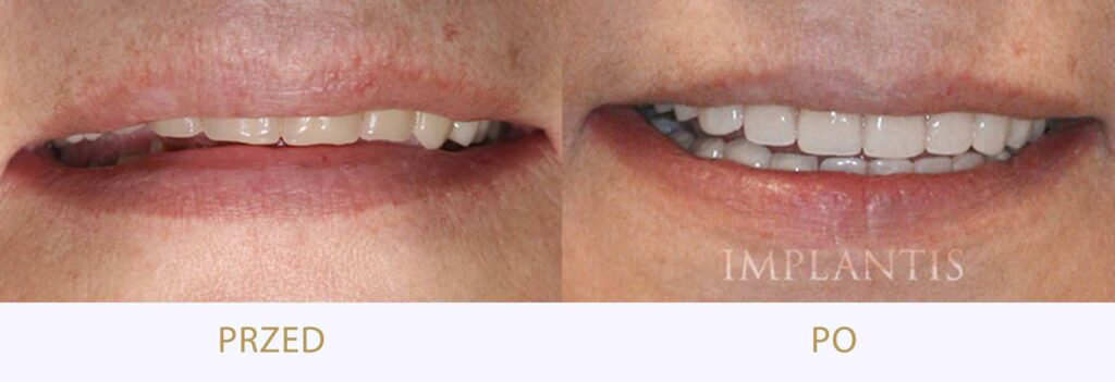 Zęby przed i po leczeniu: Rekonstrukcja uśmiechu: implanty, korony, licówki