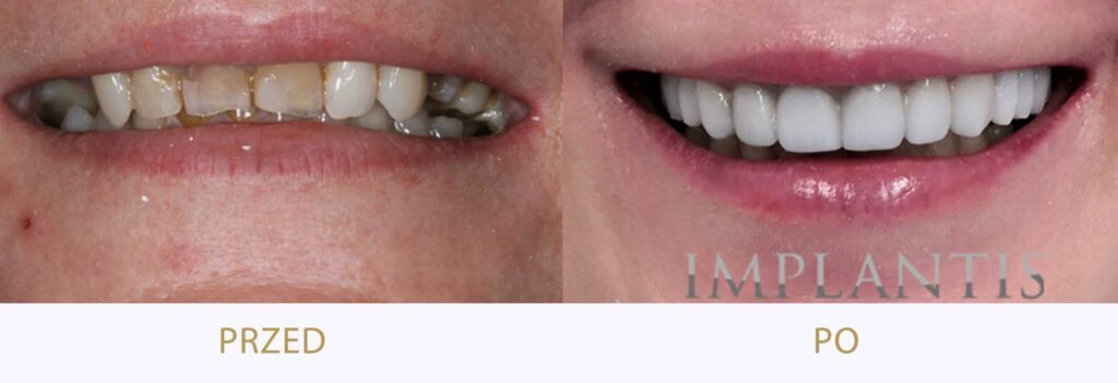 Zęby przed i po leczeniu: Rekonstrukcja uśmiechu: korony, licówki, mosty