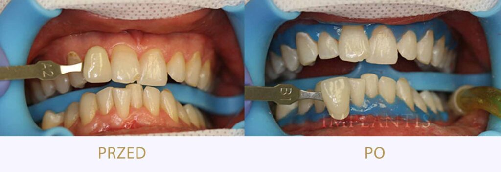 Zęby przed i po leczeniu: Wybielanie zębów