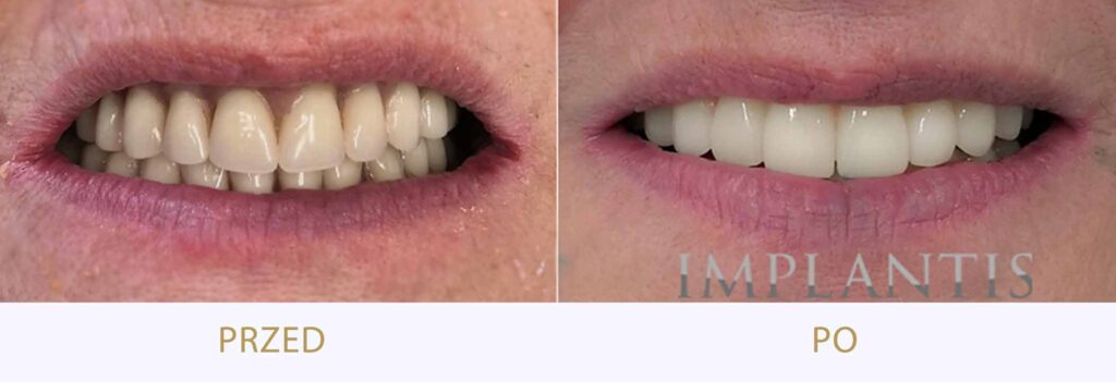 Zęby przed i po leczeniu: Wymiana protezy