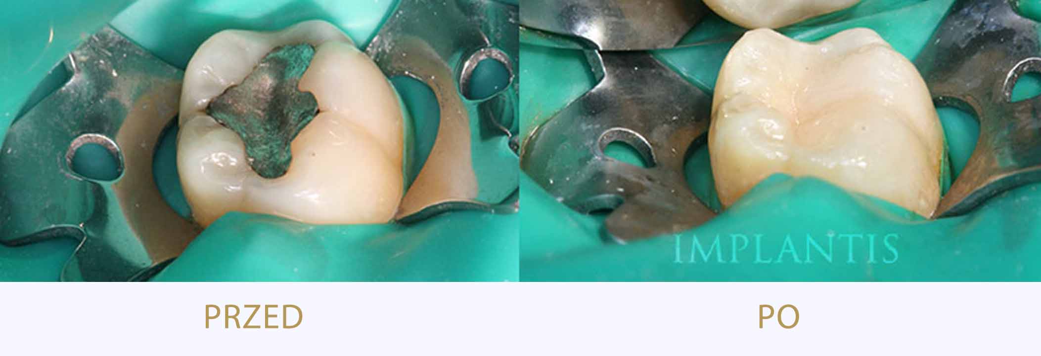 zęby przed i po leczeniu Inlay Onlay
